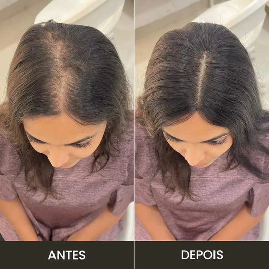 Top Closure - Topo de Cabelo com Franja 45cm | Para Alopecia e Falhas