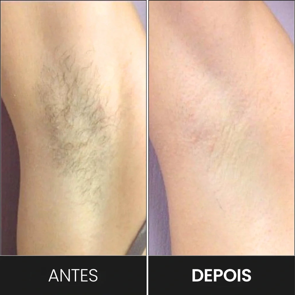 Depiladora IPL BelaVital + 2 Brindes