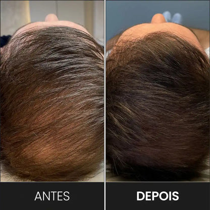 Eletrodo Pente 5 Dentes P/ Alta Frequência | Derma Capilar™