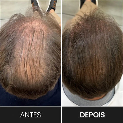 FEG Plus+: Spray de Crescimento Capilar Intensivo