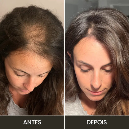 Derma Capilar | Aparelho de Alta Frequência para Tratamento Capilar e Facial