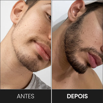 DermaRoller 0,5mm: Rolo Estimulador para Crescimento Capilar