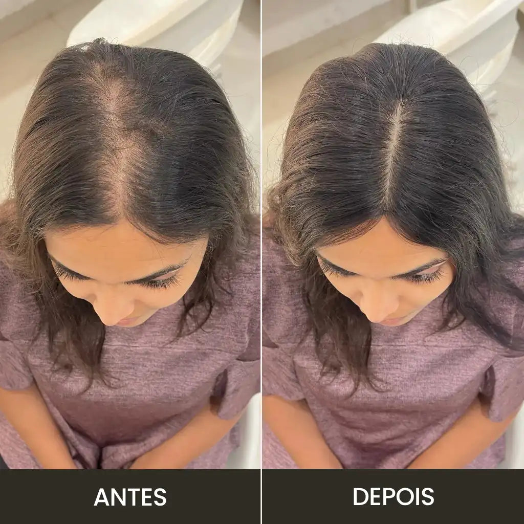 Top Closure - Topo de Cabelo com Franja 45cm | Para Alopecia e Falhas