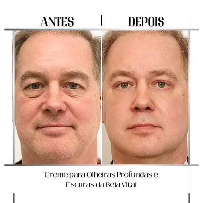 Creme para Olheiras Profundas e Escuras